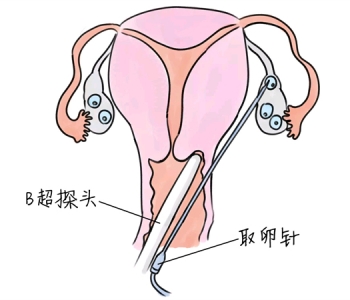 小儿退烧推拿手法 5种西安捐卵宝宝退烧按摩方法
